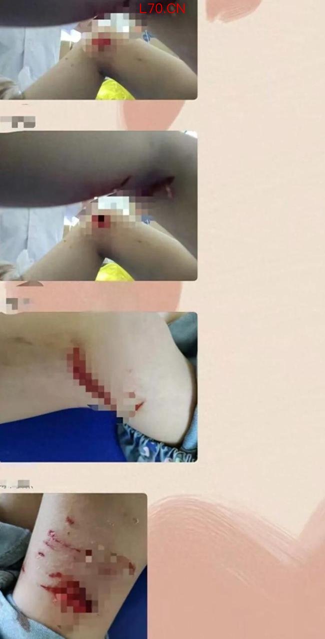 湖南多人连续4小时遭同一只狗咬伤